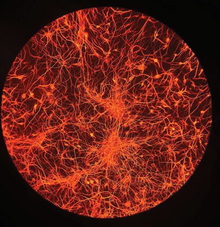 Huntington’s Disease
