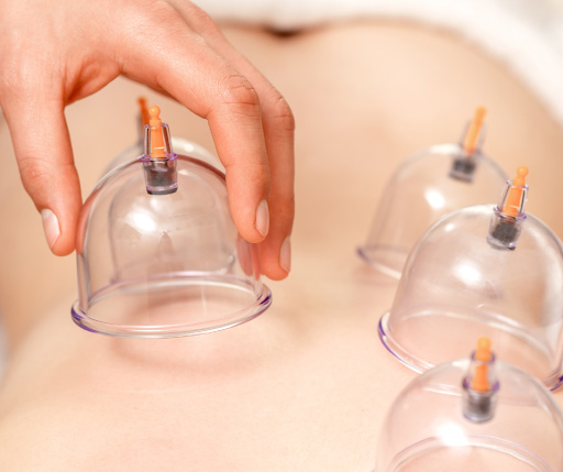 Acupuncture cups being applied to person's back