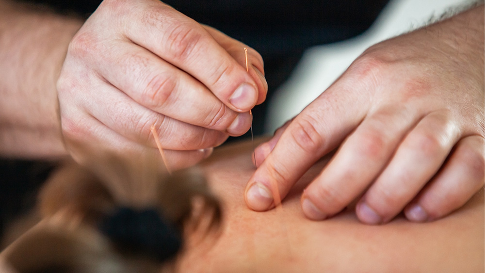 Close-up of a practitioner inserting acupuncture needles into a patient’s back during a therapeutic treatment session.