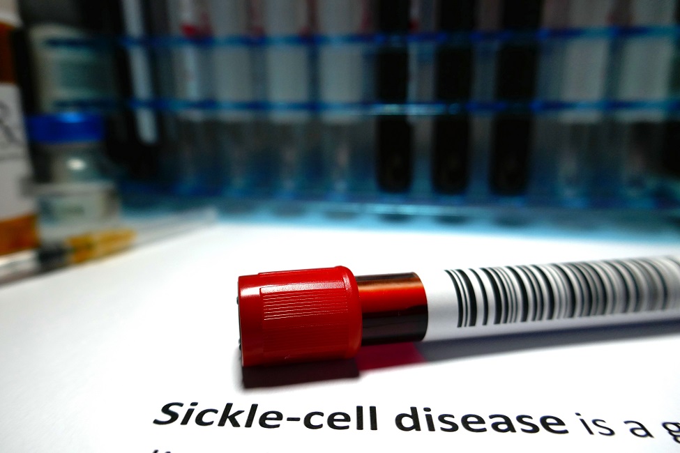 Sickle Cell Disease, Microfluidics, Technology, Engineering, Hematology, Blood Disorders, Genetic Diseases