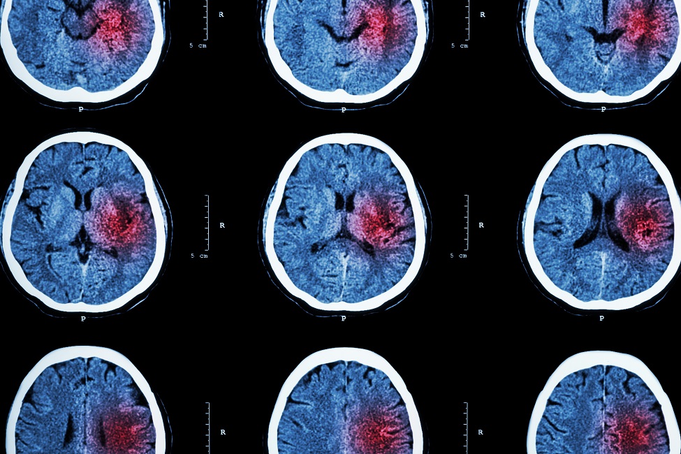 Innovative Stroke Treatment Leads to Patent Applications