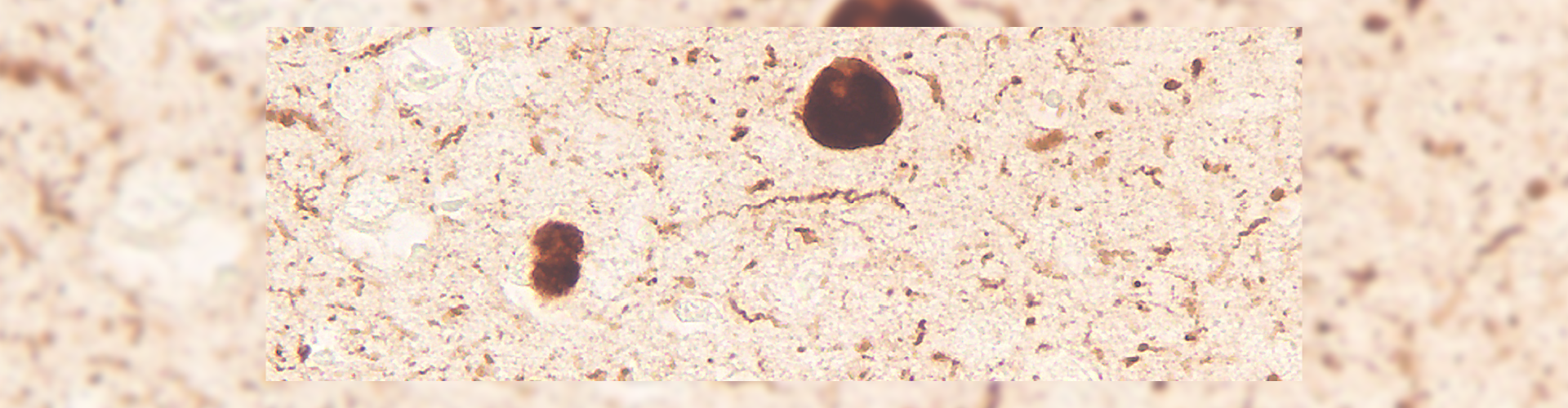 A picture of Parkison's Disease