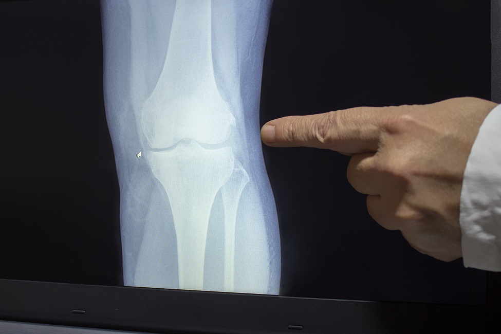STUDY FIRST TO EXAMINE OSTEOARTHRITIS AND RISK OF DEATH